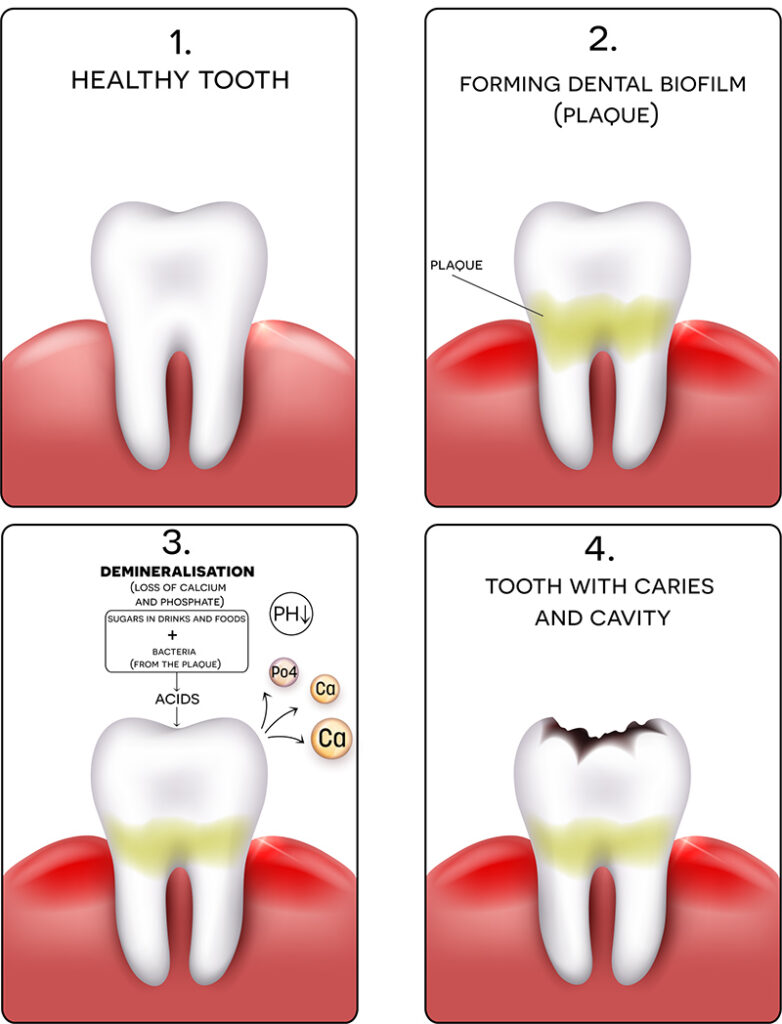 are dental cavities contagious? by innocent nnabuike uzuh (dr iyke)