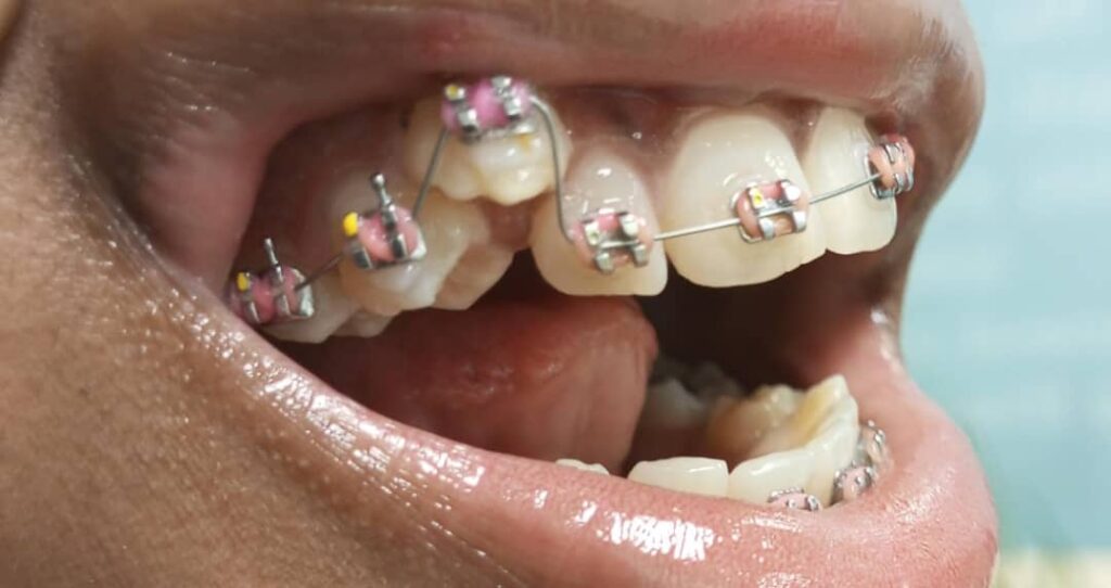 can adults wear dental braces?